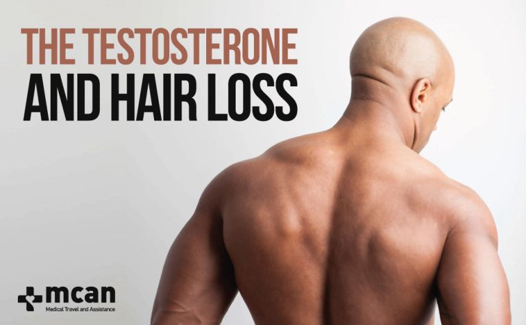 Is There Any Correlation Between Testosterone And Hair Loss 7449