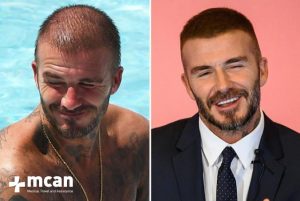 Famous Men Who Had Fue Hair Transplantation Mcan Health famous men who had fue hair