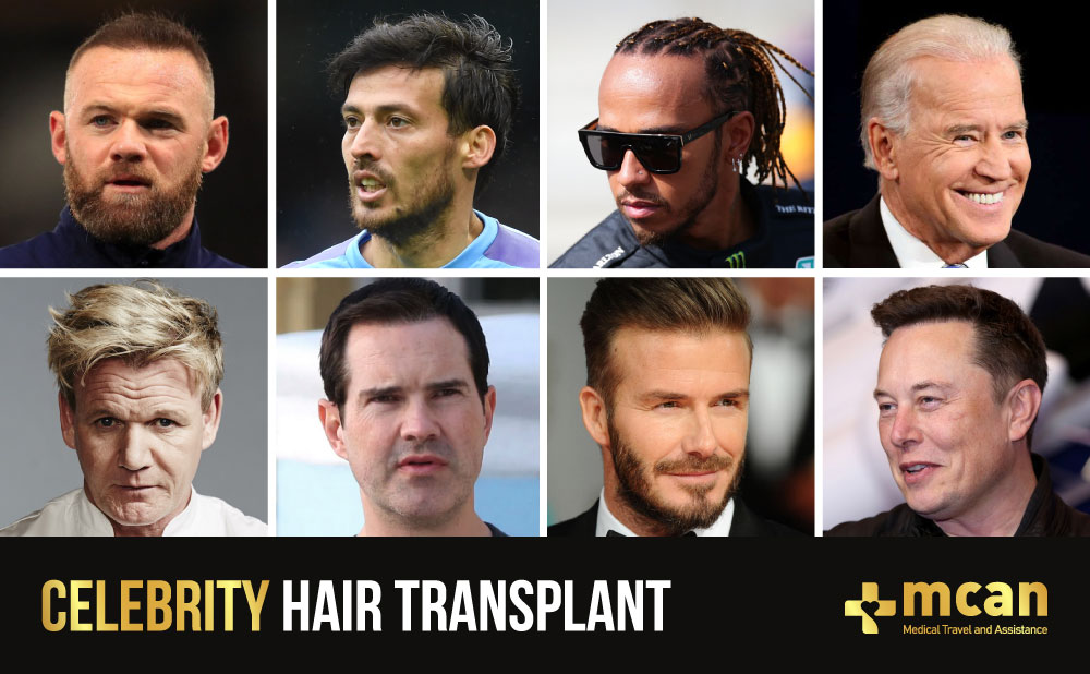celebrity hair transplant before and after