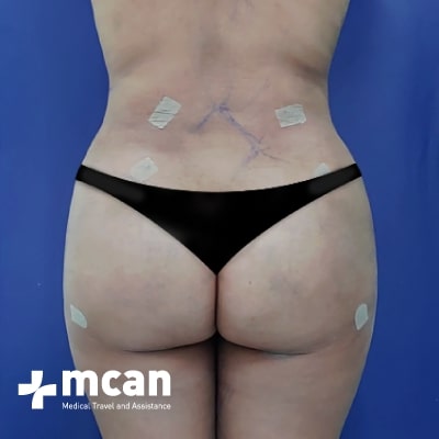 Liposuccion En Turquia Lipoescultura Vaser Mcan Health