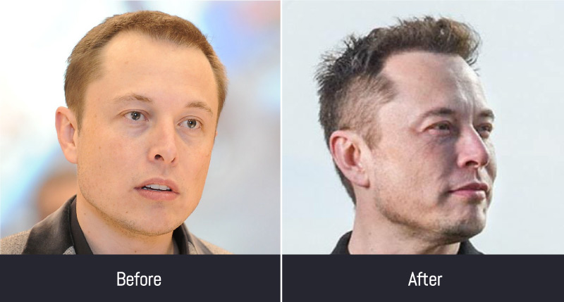 Everything About Elon Musk Hair Transplant