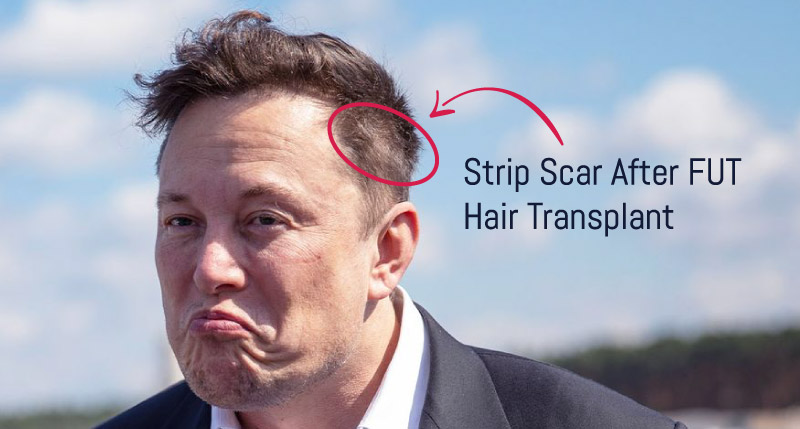 Elon Musk Strip Scar After FUT Hair Transplant