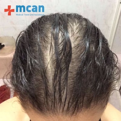 Best Hair Transplant Turkey - Get Hair Transplant Now - MCAN Health