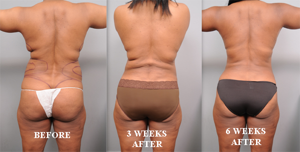Liposuction Recovery: A Week by Week Guide - Omaha Liposuction by