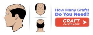 Graft Calculator for Hair Transplant - MCAN Health