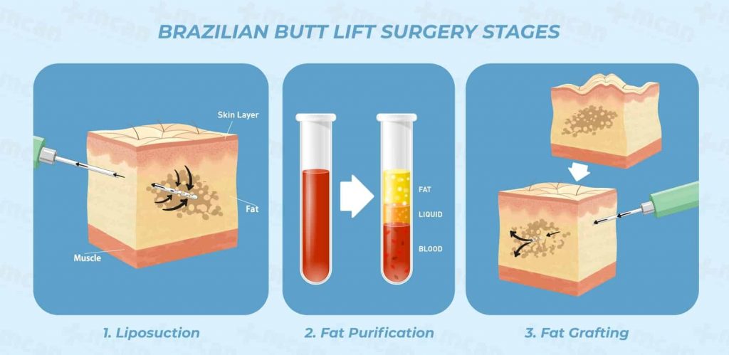 Brazilian Butt Lift In Turkey Butt Augmentation Bbl Turkey Mcan Health 5476