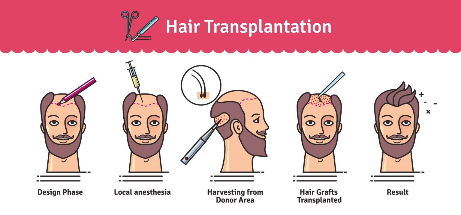 Can You Cover The Entire Head With Hair Transplant?