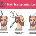 Can You Cover the Entire Head with Hair Transplant?