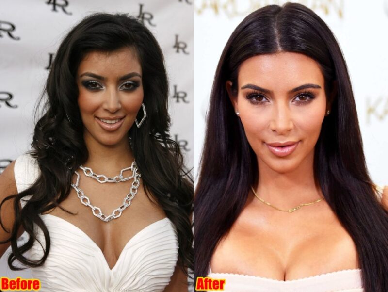 Kim Kardashian Plastic Surgery Journey Before & After (2023)