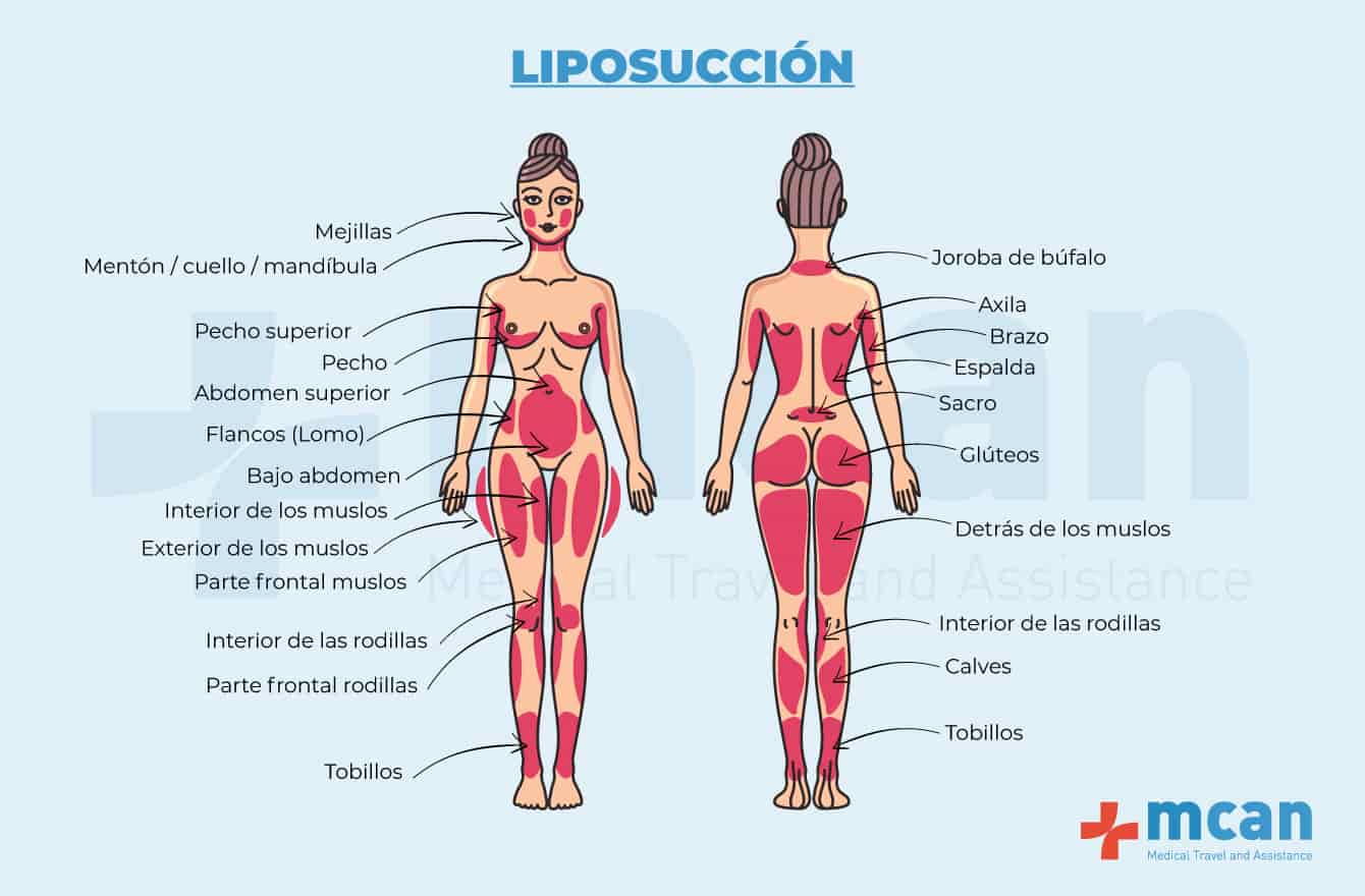 Liposuccion En Turquia Lipoescultura Vaser Mcan Health