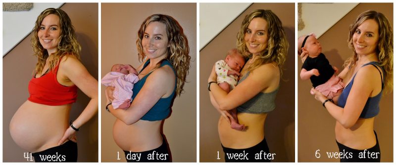 Breast implants before and after pregnancy
