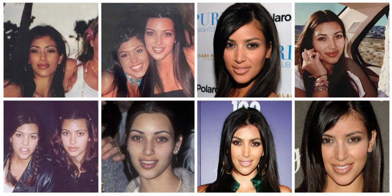 Kim Kardashian Plastic Surgery Journey Before After