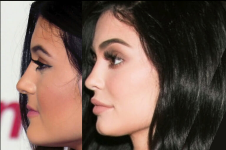 Kylie Jenner Before And After All Of Her Plastic Surgery 5815