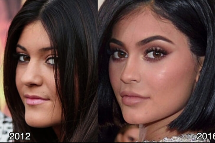 Kylie Jenner Before and After ? All of her Plastic Surgery!