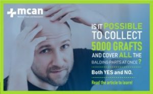 can hair transplant cover the whole head blog
