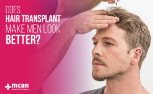 does hair transplant make men look better blog