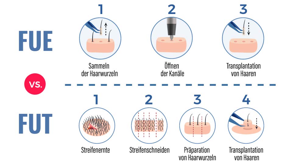 Fue Haartransplantation Turkei Haarverpflanzung Mcan Health