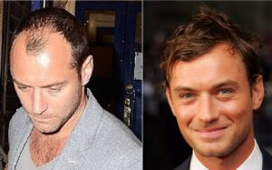 Jude Law Hair Transplant