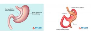 manga gastrica bypass gastrico