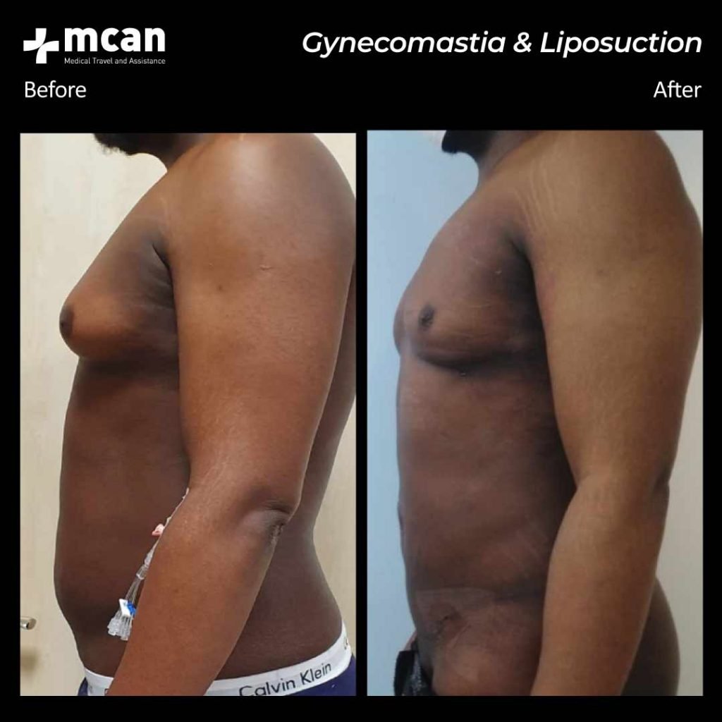 gynecomastia mcan health before after