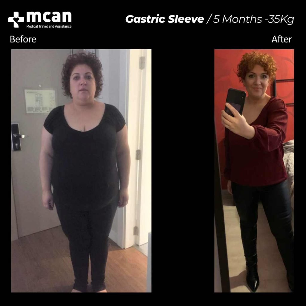 Before & After Bariatric | MCAN Health