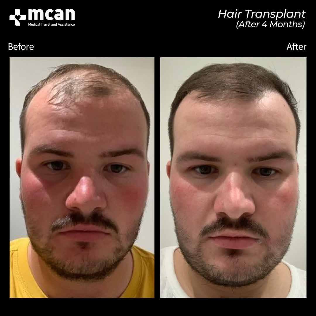 Hair Transplant Turkey, Best Hair Transplant In Istanbul, Turkey