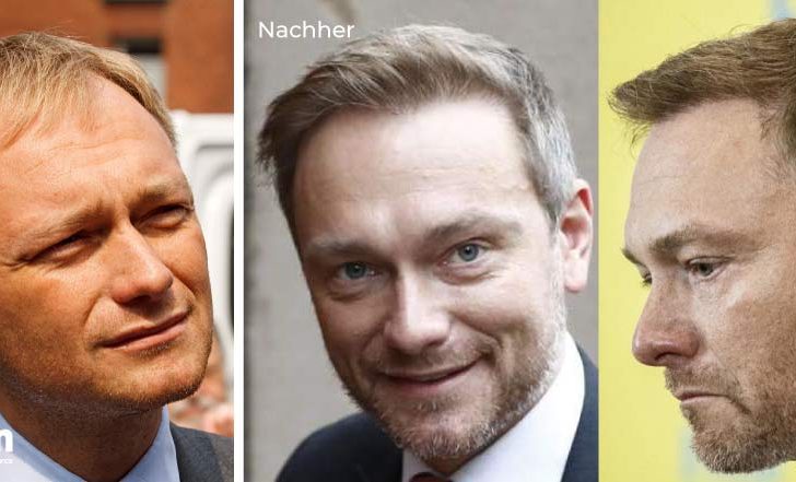 Haartransplantation Nur Für Promis? Das War Gestern! - Hair Transplant ...