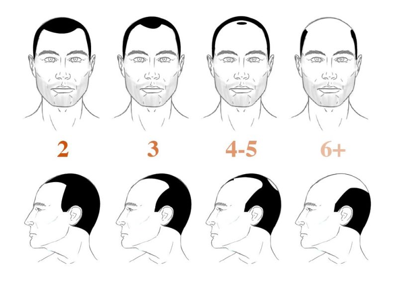 How Many Grafts are Needed for a GREAT Hair Transplant?