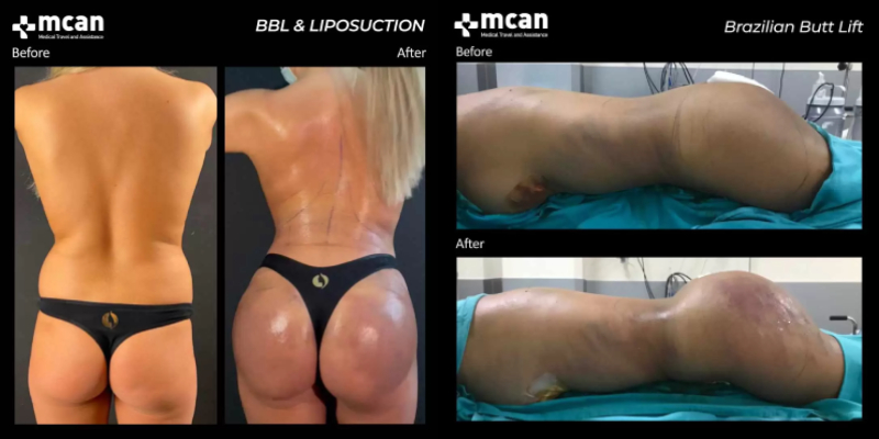 How Much Is The Brazilian Buttlift Surgery In Turkey - BBL