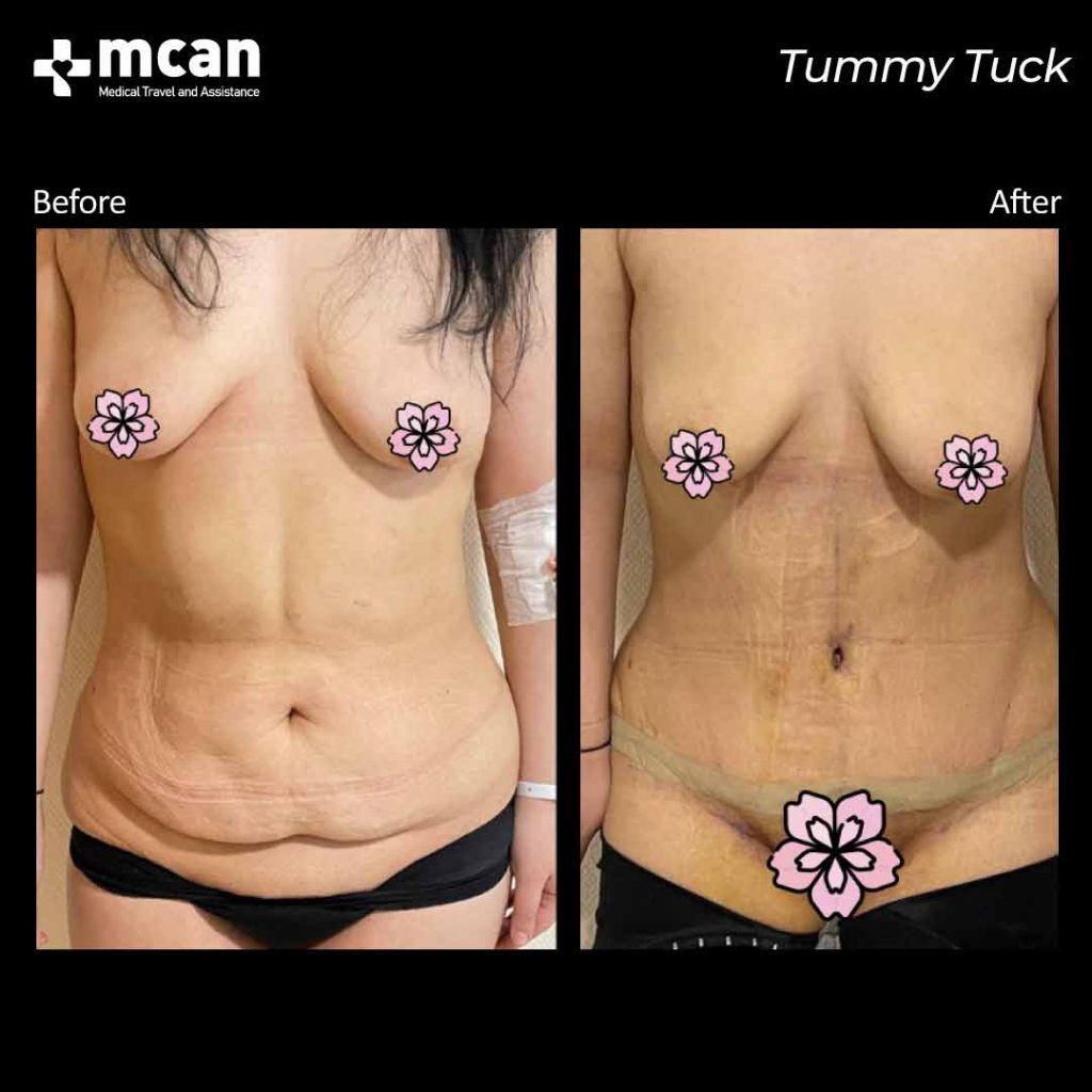 TUMMY TUCK BEFORE AND AFTER