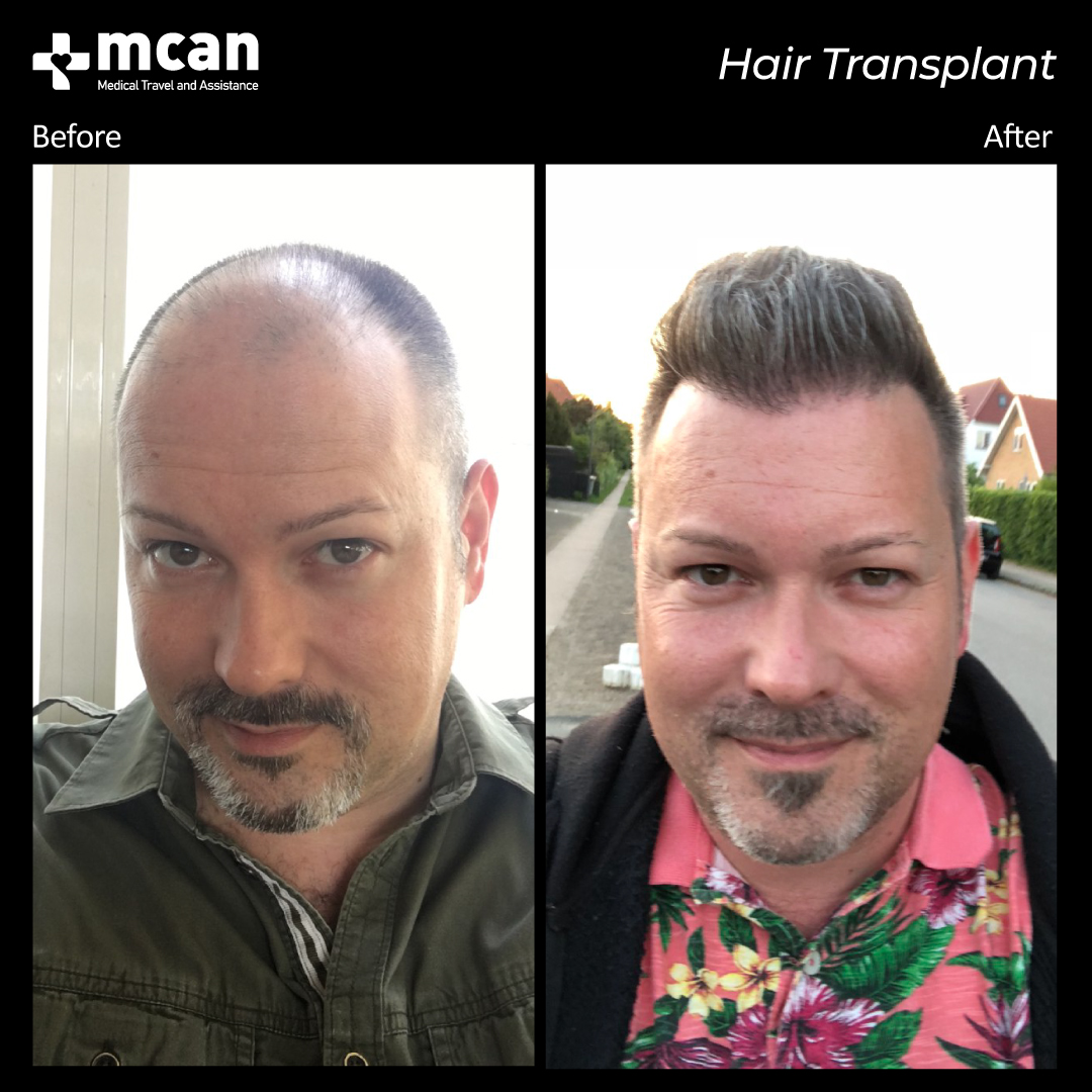 Elit Hair Transplant Turkey - DrBalwi - This patient looks 10 years  younger after his hair transplantation, do you like it? - Facebook