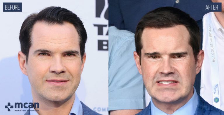 All About Jimmy Carr Hair Transplant and Cosmetic Surgeries