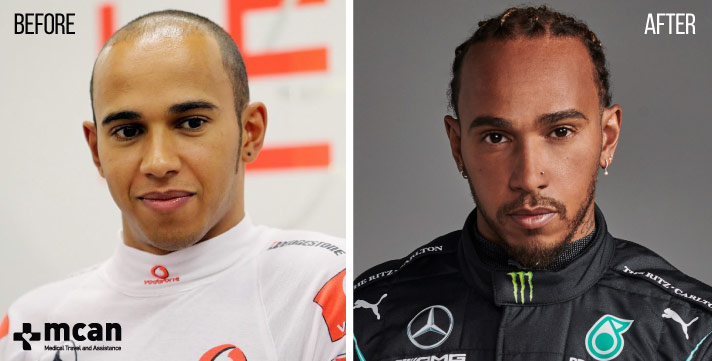 Has Lewis Hamilton Had a Hair Transplant