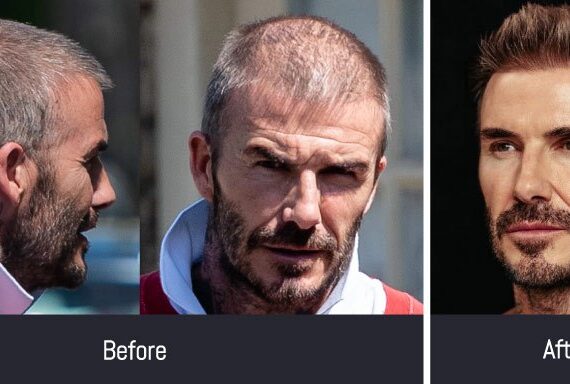 Celebrity Hair Transplants and their before and after photos