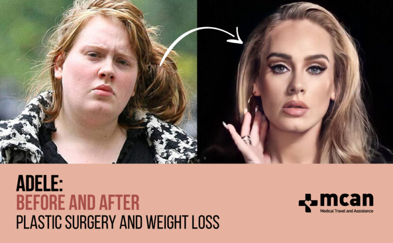 adele skinny after surgery