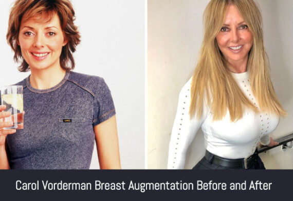 Carol Vorderman Plastic Surgery Journey True Or False