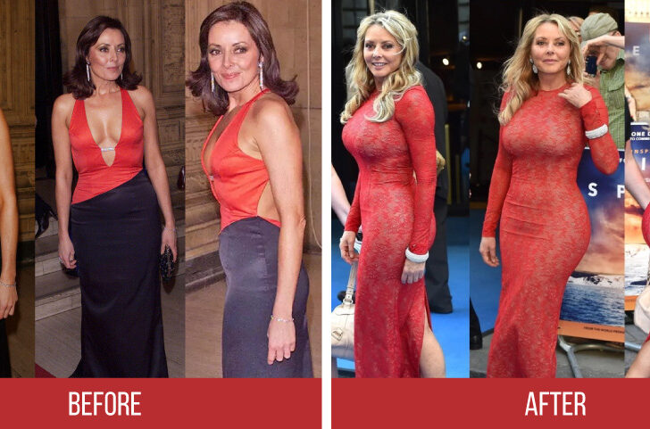 Carol Vorderman Plastic Surgery Journey True Or False 