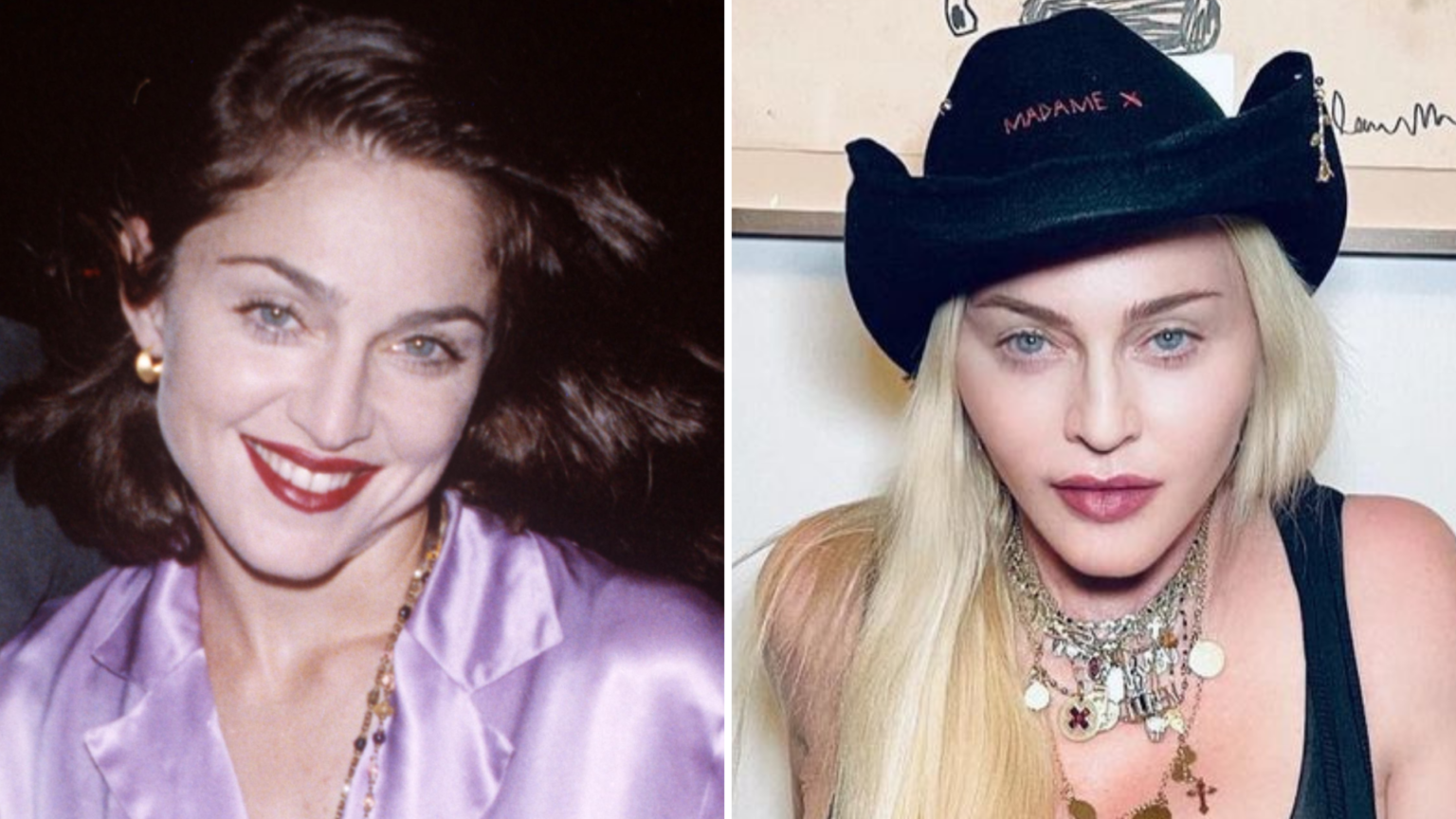 Madonna Plastic Surgery Facts! ? All About Her Operations