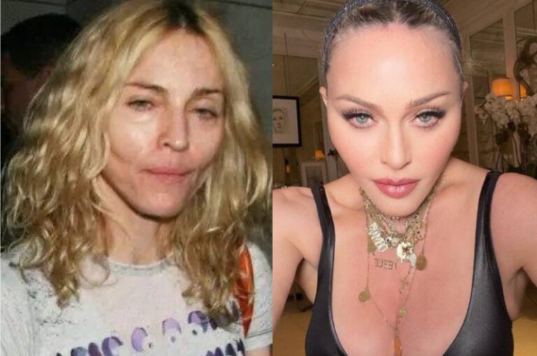 Madonna Plastic Surgery Facts! ? All About Her Operations