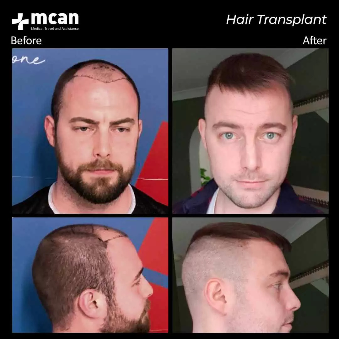 Cost of Hair Transplant - Package Prices - Surgery TR