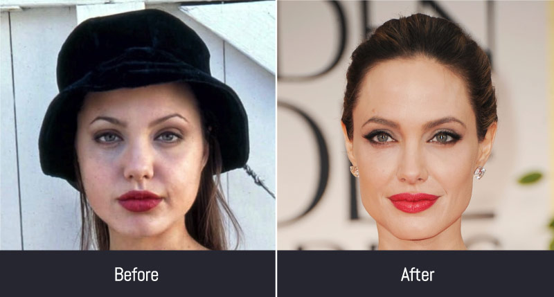 Angelina Jolie Before After Plastic Surgery 