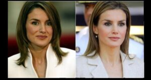 Reina Letizia antes y después de su mentoplastia