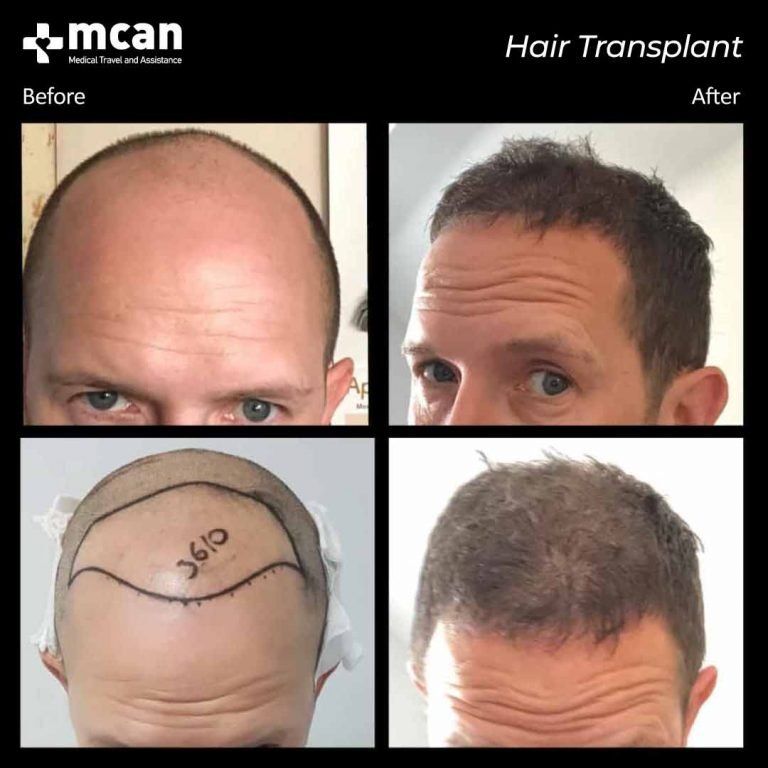 Haartransplantation Türkei Istanbul Mcan Health