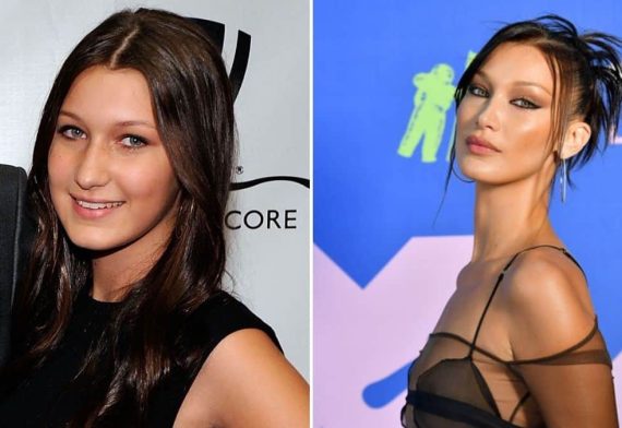 Bella Hadid Antes Y Despu S De Sus Operaciones Mcan Health