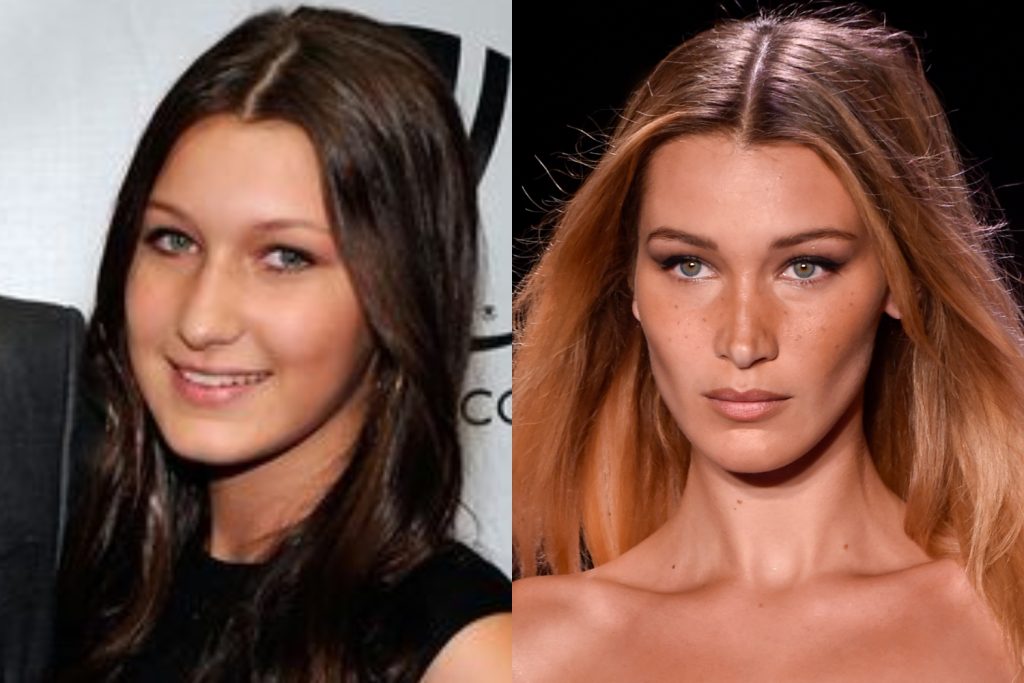 Bella Hadid antes y después de sus operaciones MCAN Health