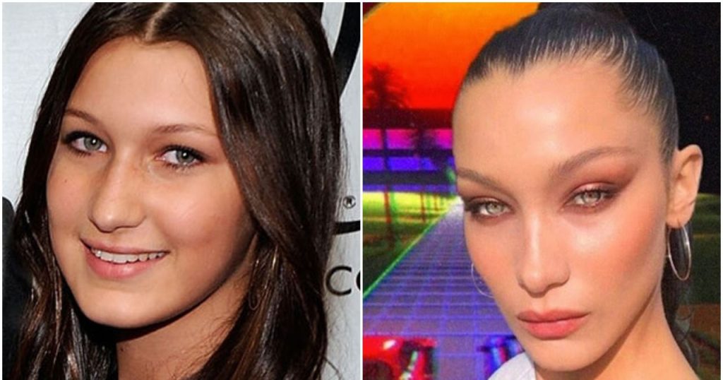 Bella Hadid antes y después de su blefaroplastia