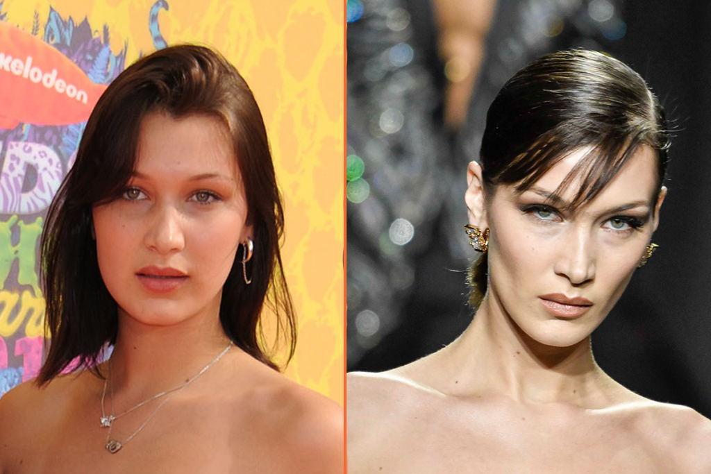 Bella Hadid antes y después filler de pómulos