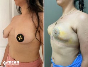 BREAST LIFT 10