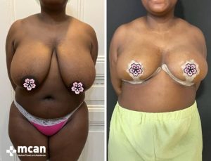 BREAST LIFT 11