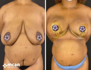 BREAST LIFT 12